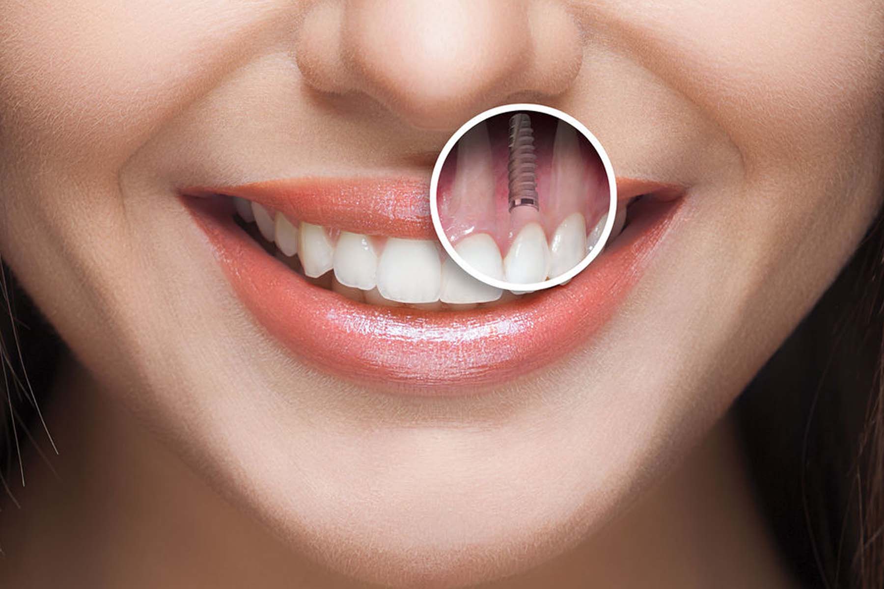 Dental Implants