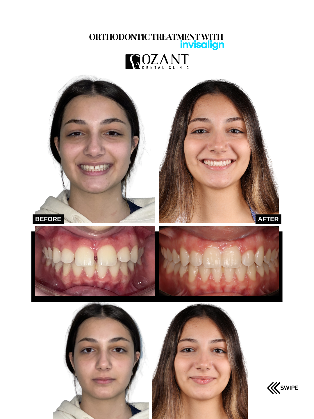 Dişlerimin Arası Neden Açık? Lefkoşa’da Şeffaf Plaklarla Diastema Tedavisi